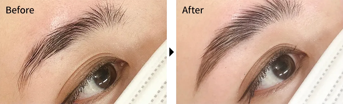 HOLLYWOOD BROW LIFT Before After